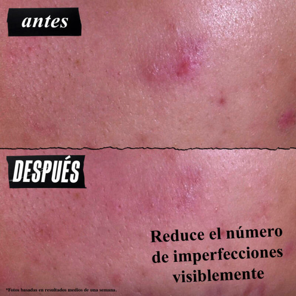 gently-effective-blemish-targeting-tratamento-de-limpeza-para-acne
