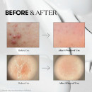 reedle-shot-100-glow-effect-microneedling-treatment