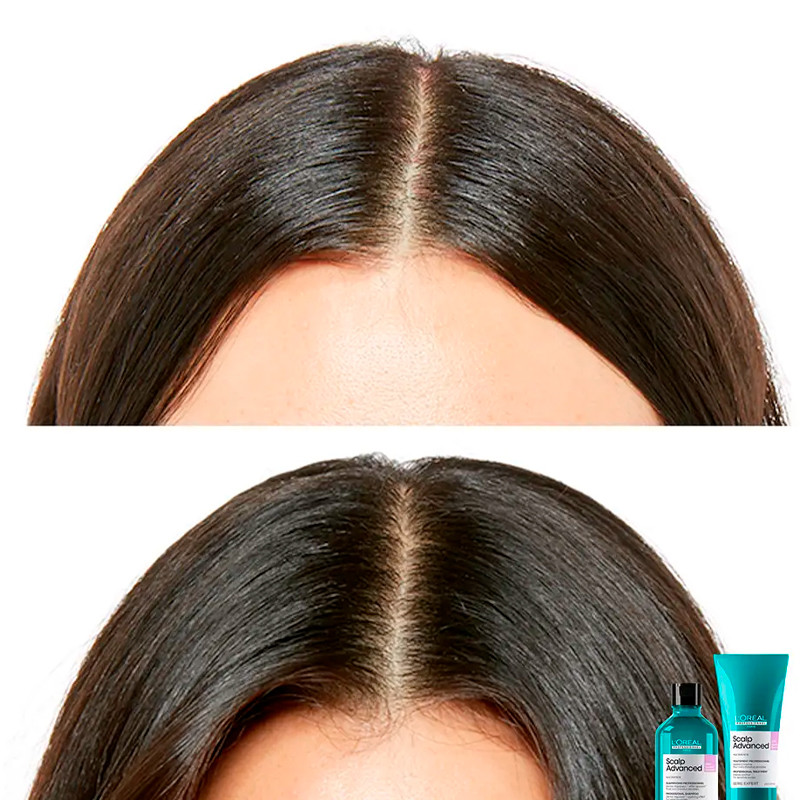 Loreal Professionnel Scalp Advanced Champú Anti Malestar