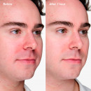 anti-blemish-solutions-clinical-gel-anti-imperfeicoes-avancado
