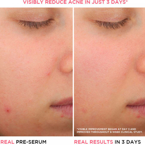 bye-bye-breakout-serum-de-acido-salicylico